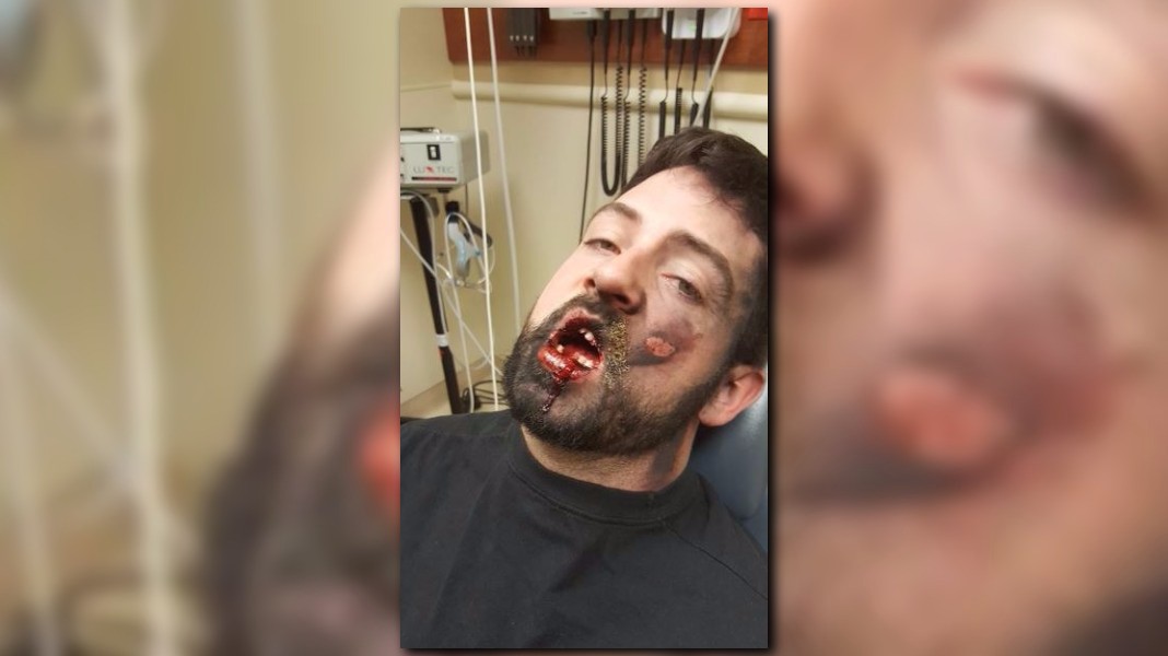 GRAPHIC IMAGES Man hospitalized after vape pen allegedly explodes